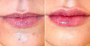 lip flip before and after